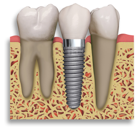Many people go to Mexico for implants